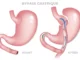 Chirurgie Obésité : BYPASS BYPASS GASTRIQUE | CHIRURGIE BARIATRIQUE | CHIRURGIE DE L'OBÉSITÉ INTERNATIONAL MEDICAL SERVICE AGENCY