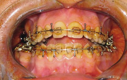 Les Implants dentaires avec IMSA BLANCHIMENT DENTAIRE | CHIRURGIE DENTAIRE | CHIRURGIE ESTHÉTIQUE INTERNATIONAL MEDICAL SERVICE AGENCY
