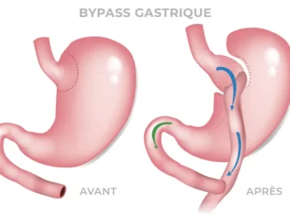 Chirurgie Obésité : BYPASS SLEEVE GASTRECTOMIE INTERNATIONAL MEDICAL SERVICE AGENCY