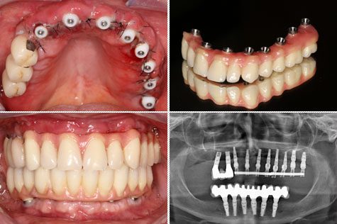 Les Prothèses Esthétiques Dentaires BLANCHIMENT DENTAIRE | CHIRURGIE DENTAIRE | CHIRURGIE ESTHÉTIQUE INTERNATIONAL MEDICAL SERVICE AGENCY