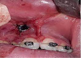 Dentisterie Chirurgicale et Soins Dentaires BLANCHIMENT DENTAIRE | CHIRURGIE DENTAIRE | CHIRURGIE ESTHÉTIQUE INTERNATIONAL MEDICAL SERVICE AGENCY