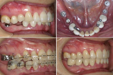 Les Prothèses Esthétiques Dentaires BLANCHIMENT DENTAIRE | CHIRURGIE DENTAIRE | CHIRURGIE ESTHÉTIQUE INTERNATIONAL MEDICAL SERVICE AGENCY